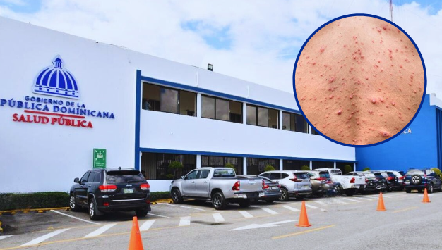 ministerio-de-salud-fortalece-vigilancia-ante-declaracion-de-emergencia-de-la-oms-sobre-viruela-simica