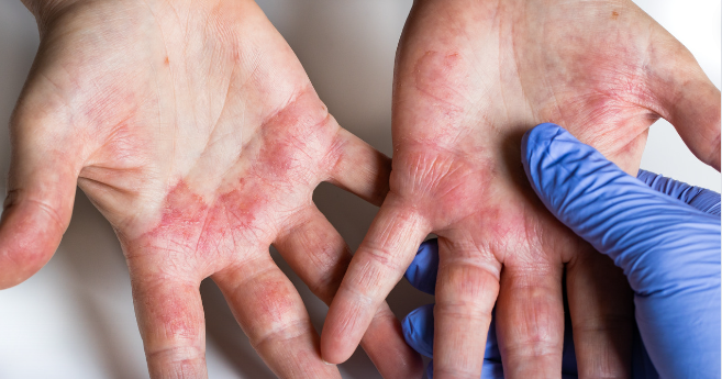 dia-mundial-de-la-dermatitis-atopica