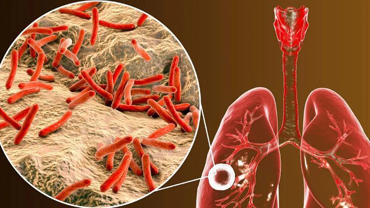 tras-deteccion-de-tuberculosis-autoridades-de-salud-refuerzan-medidas-sanitarias-en-constanza