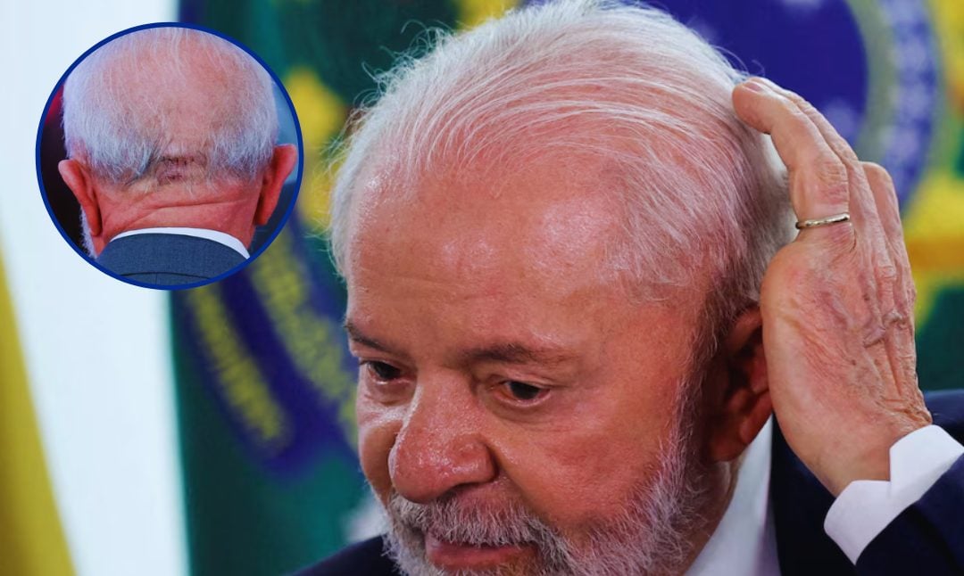 lula-da-silva-volvera-a-ser-operado-por-la-lesion-en-la-cabeza