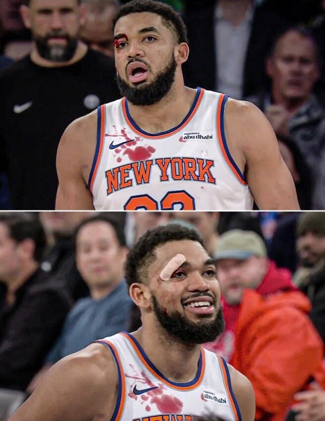 corte-en-ojo-derecho-no-detuvo-a-anthony-towns-en-victoria-knicks